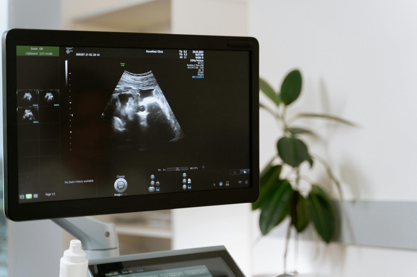 Single uterine puncture through the intertwin membrane in twin pregnancy